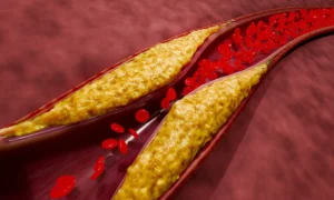 cholesterol