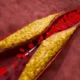 cholesterol